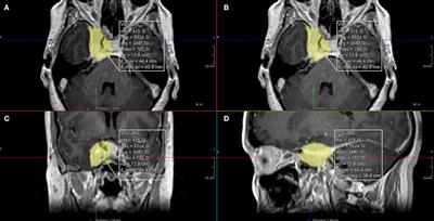 Improving Function in Cavernous Sinus Meningiomas: A Modern Treatment Algorithm